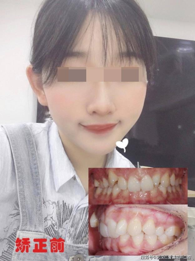 武漢仁愛口腔 ▏00后小姐姐整牙逆襲記!