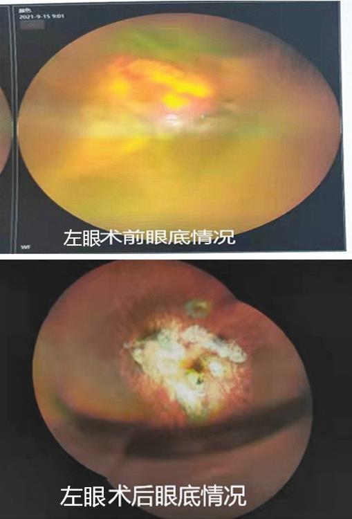 2500度超高度近視又白內(nèi)障又眼底問題 上海眼科醫(yī)生“一提一!敝委煼桨竿炀人