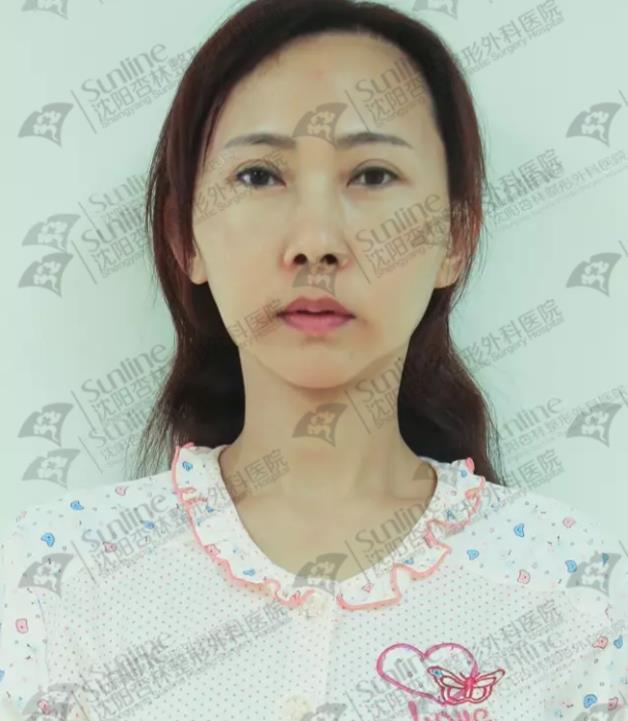 沈陽(yáng)杏林整形外科醫(yī)院自體脂肪面部填充費(fèi)用