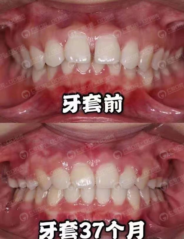 武漢仁愛口腔隱形矯正案例 看這位嘴突女生如何成功逆襲