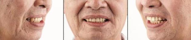 武漢仁愛口腔為65歲李叔做全口即刻負(fù)重種植術(shù),當(dāng)天換得一口好牙!