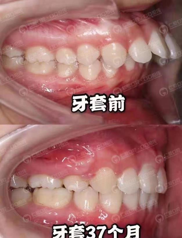 武漢仁愛口腔隱形矯正案例 看這位嘴突女生如何成功逆襲