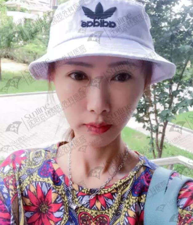 沈陽(yáng)杏林整形外科醫(yī)院自體脂肪面部填充費(fèi)用