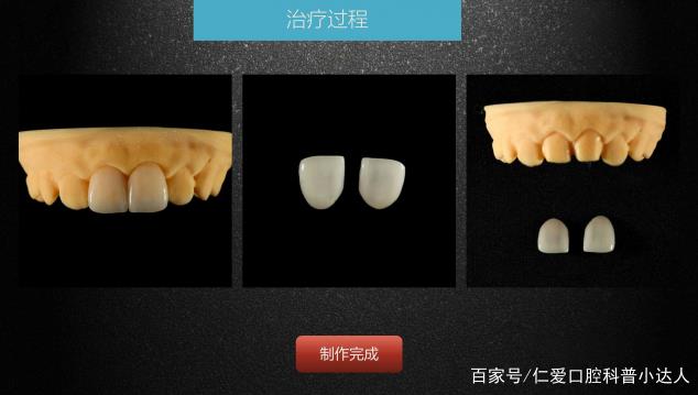 武漢仁愛(ài)口腔 數(shù)字化即刻美學(xué)貼面案例分享