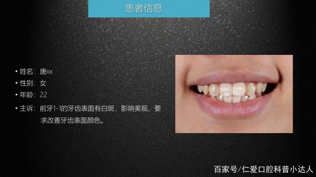 武漢仁愛(ài)口腔 數(shù)字化即刻美學(xué)貼面案例分享