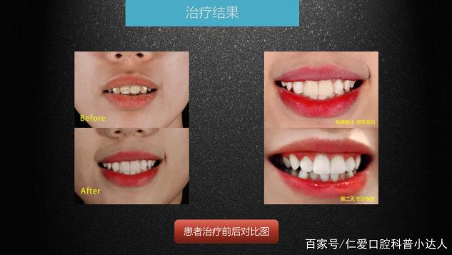 武漢仁愛(ài)口腔 數(shù)字化即刻美學(xué)貼面案例分享