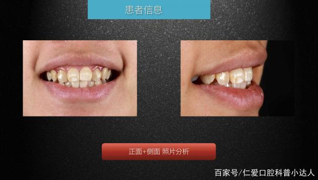武漢仁愛(ài)口腔 數(shù)字化即刻美學(xué)貼面案例分享