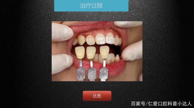 武漢仁愛(ài)口腔 數(shù)字化即刻美學(xué)貼面案例分享