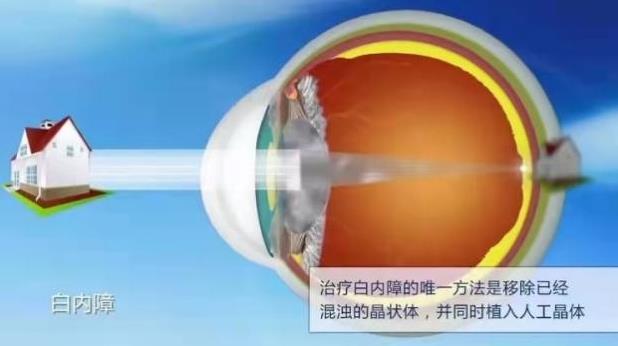上海眼科專家化身主播,中秋佳節(jié)陪老人家共話白內(nèi)障、老花那些事