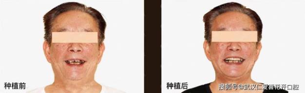 武漢仁愛口腔#即刻負重攻克半口全口種植難題 當天戴牙,當天重建“真牙般咬合”