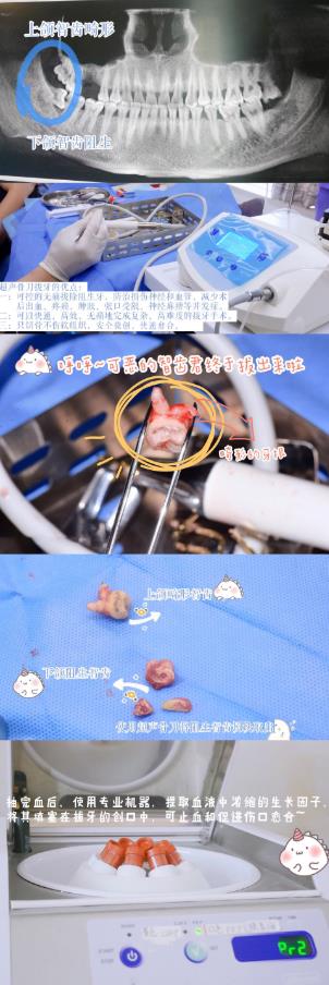 武漢仁愛口腔:微創(chuàng)無痛拔牙是真的可以做到不疼的嗎?楊醫(yī)師來告訴你真相