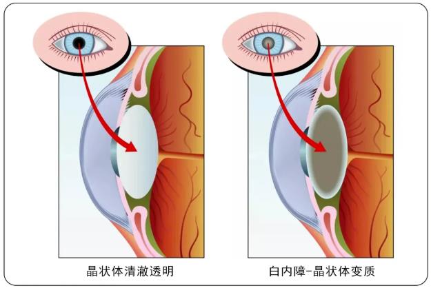 北京華德眼科醫(yī)院:別拖了!秋天是做白內障手術的黃金季節(jié)。