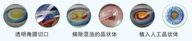 北京華德眼科醫(yī)院:別拖了!秋天是做白內障手術的黃金季節(jié)。