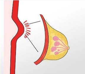 乳腺增生是什么病