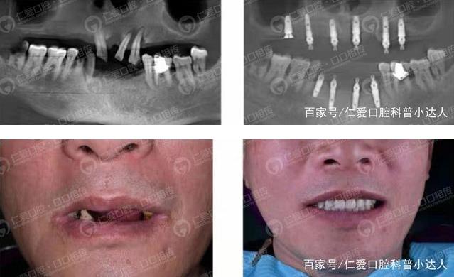 武漢種牙上午滿口無(wú)牙 下午吃嘛嘛香,讓缺牙患者瞬間擁有好口福!
