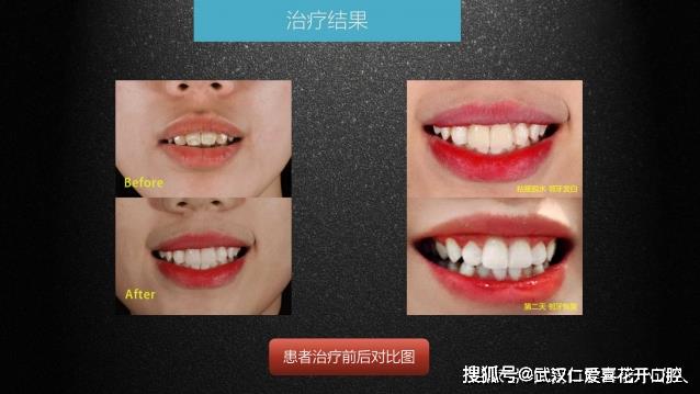武漢仁愛口腔 數(shù)字化即刻美學貼面案例分享