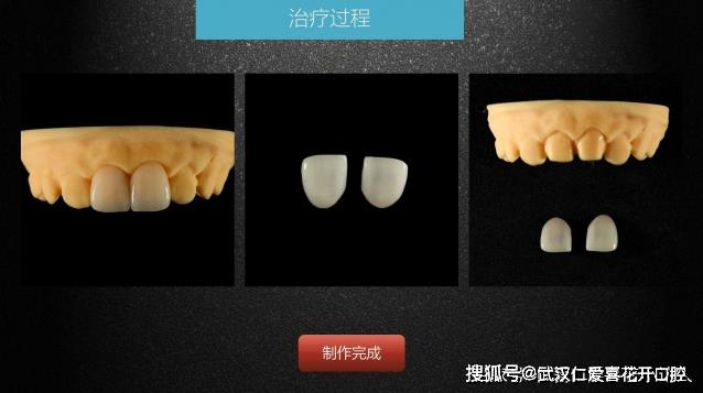 武漢仁愛口腔 數(shù)字化即刻美學貼面案例分享