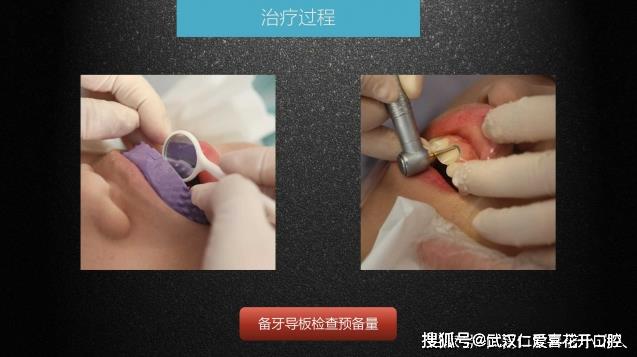 武漢仁愛口腔 數(shù)字化即刻美學貼面案例分享