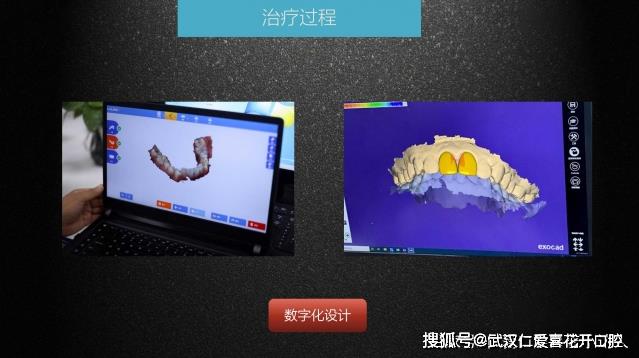 武漢仁愛口腔 數(shù)字化即刻美學貼面案例分享