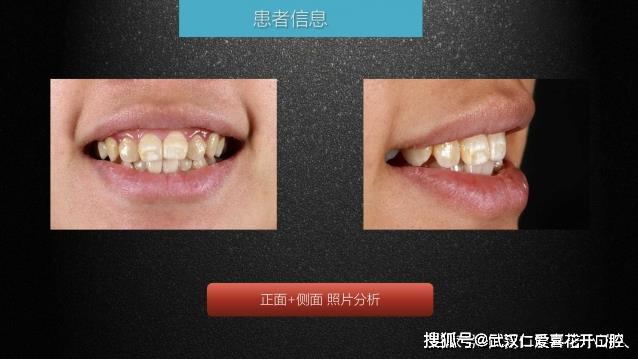 武漢仁愛口腔 數(shù)字化即刻美學貼面案例分享