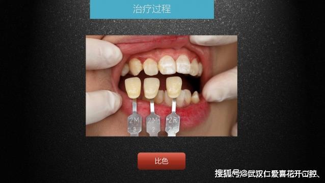 武漢仁愛口腔 數(shù)字化即刻美學貼面案例分享
