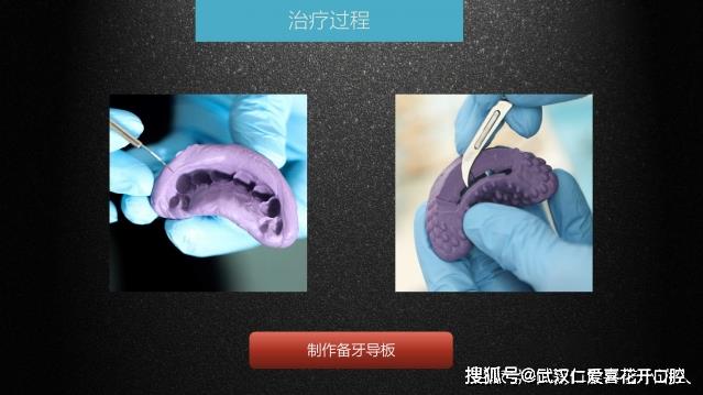 武漢仁愛口腔 數(shù)字化即刻美學貼面案例分享