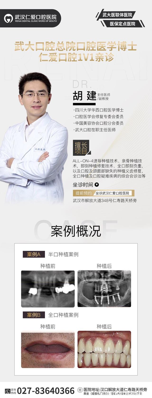 武漢種牙上午滿口無(wú)牙 下午吃嘛嘛香,讓缺牙患者瞬間擁有好口福!