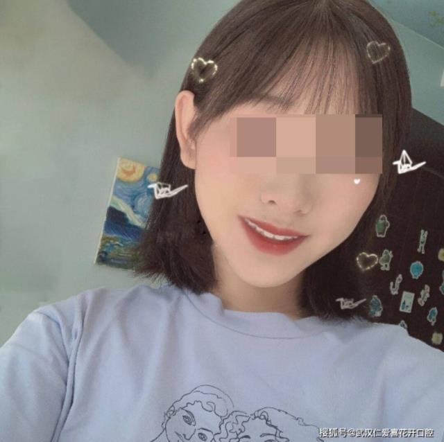 武漢仁愛口腔牙齒矯正案例分享 ▏用“牙套”換一個更美的自己!