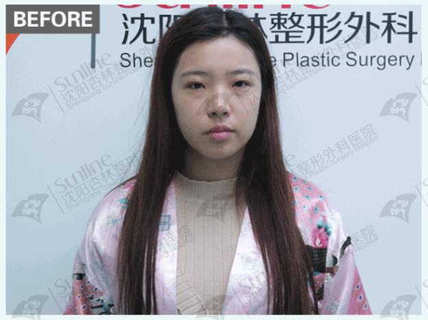 沈陽杏林整形外科醫(yī)院開眼角前后對(duì)比,有必要開眼角嗎