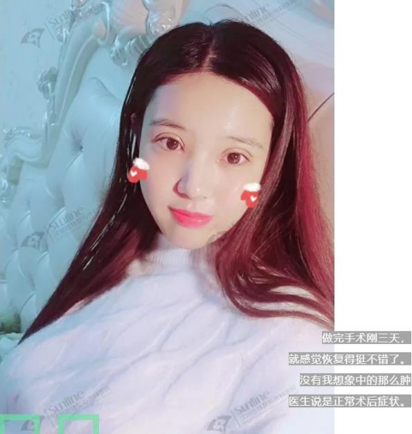 沈陽杏林整形外科醫(yī)院開眼角前后對(duì)比,有必要開眼角嗎