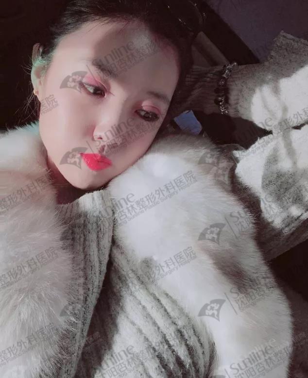 沈陽杏林整形外科醫(yī)院開眼角前后對(duì)比,有必要開眼角嗎