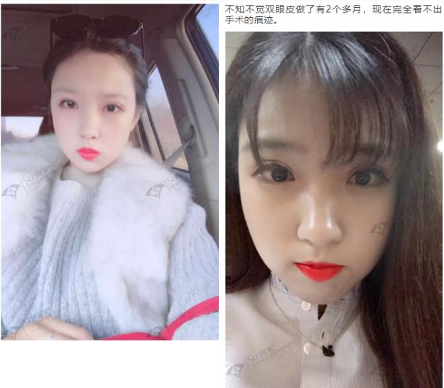 沈陽杏林整形外科醫(yī)院開眼角前后對(duì)比,有必要開眼角嗎