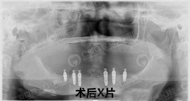武漢仁愛(ài)口腔為一位58歲大叔尋求口福的神奇之旅!