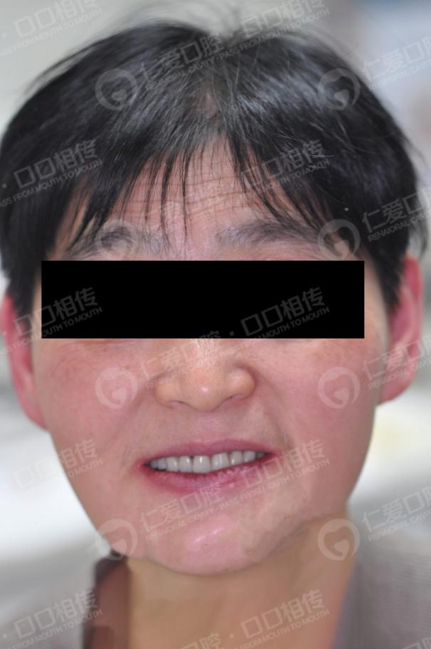 武漢仁愛(ài)口腔為一位58歲大叔尋求口福的神奇之旅!