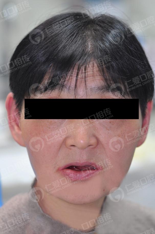 武漢仁愛(ài)口腔為一位58歲大叔尋求口福的神奇之旅!