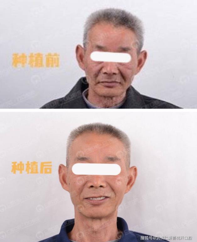 武漢仁愛口腔 重回青春——74歲老人自述種植牙全過(guò)程