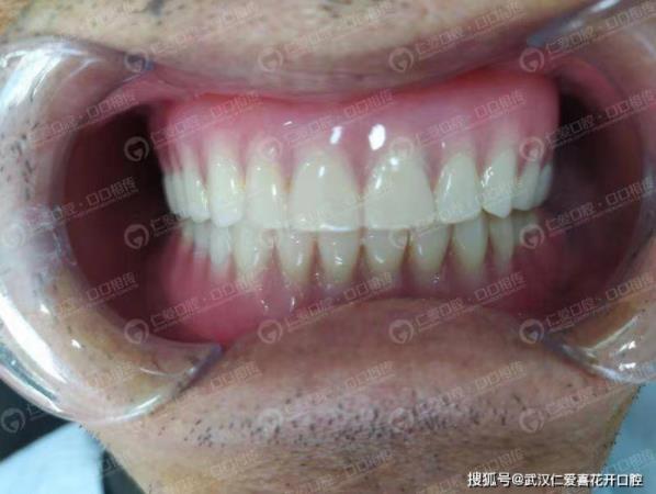 武漢仁愛口腔 重回青春——74歲老人自述種植牙全過(guò)程