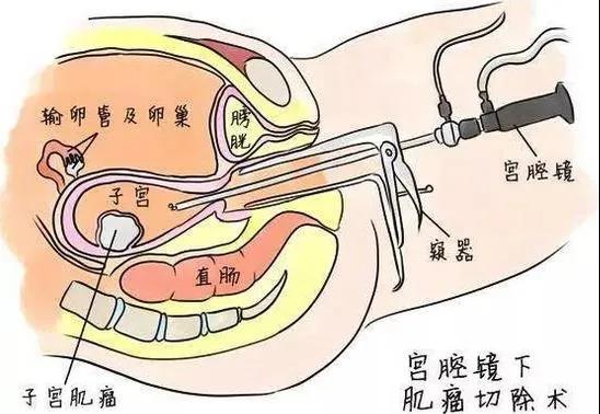 武漢仁愛(ài)醫(yī)院婦科:拿什么檢驗(yàn)?zāi)愕膶m腔是否健康,“鏡子”照一照就曉得!