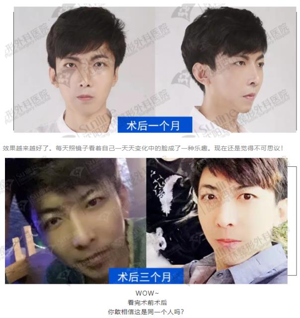 沈陽杏林整形外科醫(yī)院上下頜凸嘴矯正價格表,沈陽哪能削骨
