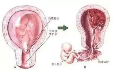 北京安太醫(yī)院高位宮頸環(huán)扎術(shù) 狙擊晚期流產(chǎn)