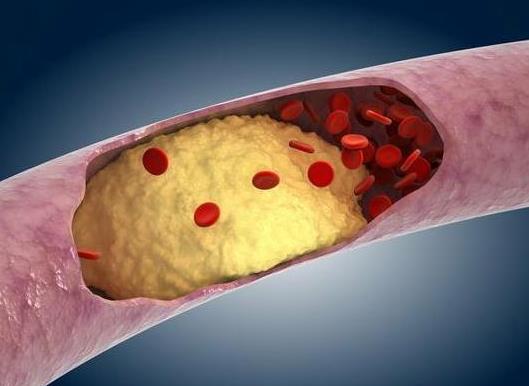 急性胰腺炎治愈后能一生不復發(fā)嗎?急性胰腺炎怎么治療?