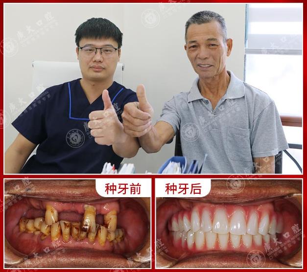 廣州種植牙醫(yī)院高齡老人也可當(dāng)天種牙當(dāng)天用!廣東省愛牙工程公益執(zhí)種機(jī)構(gòu)廣大口腔精種好牙