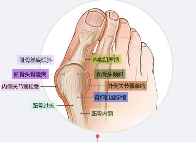 上海虹橋醫(yī)院張樹偉治療拇外翻怎么樣呢?