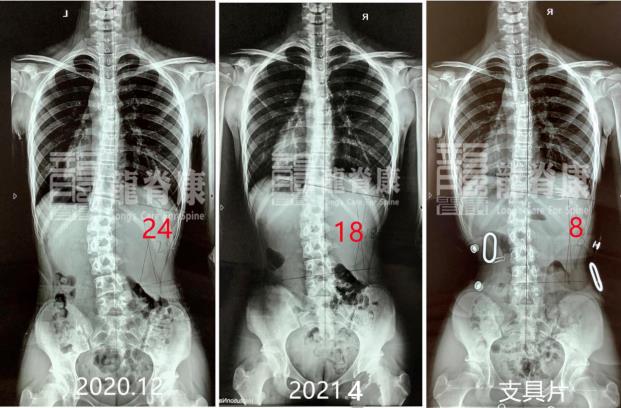 深圳龍脊康黃耿沛主任:脊柱側(cè)彎如何科學(xué)預(yù)防