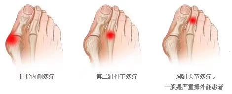 您關(guān)心的拇外翻知識,龍德剛主任帶您了解
