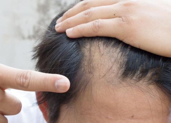 脫發(fā)都有哪些原因?每天掉多少頭發(fā)就提示有異常?