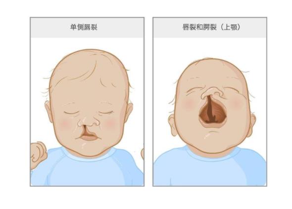 唇腭裂的圖片,導(dǎo)致唇腭裂的相關(guān)因素有哪些?
