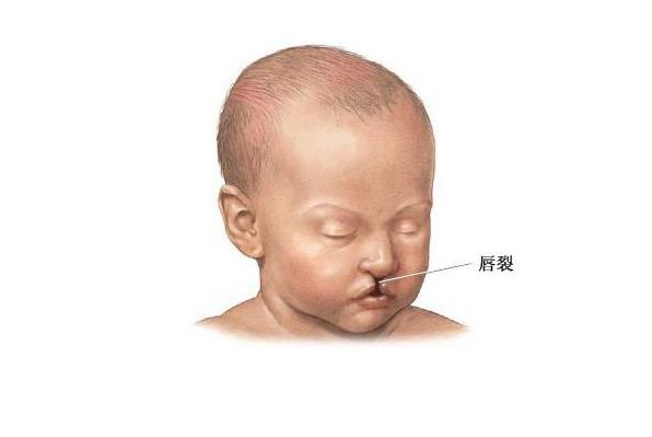唇腭裂的圖片,導(dǎo)致唇腭裂的相關(guān)因素有哪些?