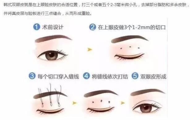 聽聽王的整形王海木院長分享雙眼皮避坑指南