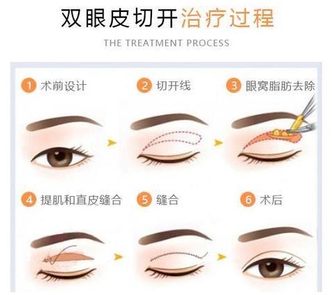聽聽王的整形王海木院長分享雙眼皮避坑指南